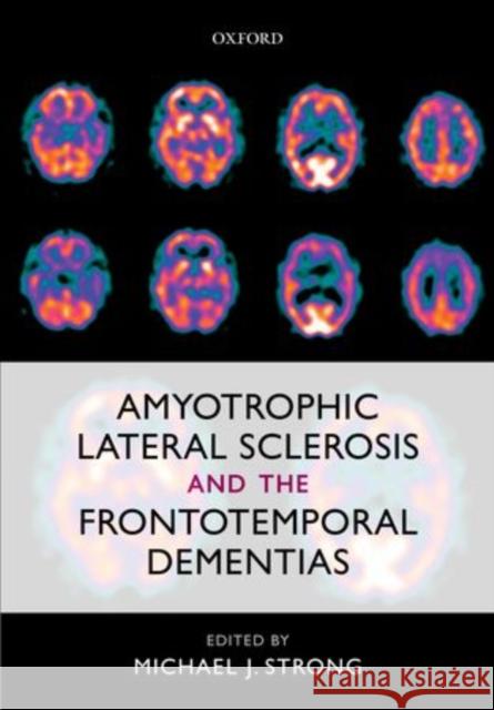 Amyotrophic Lateral Sclerosis and the Frontotemporal Dementias Michael J. Strong 9780199590674