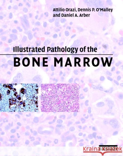 Illustrated Pathology of the Bone Marrow Attilio Orazi Daniel A. Arber Dennis P. O'Malley 9780521810036 Cambridge University Press