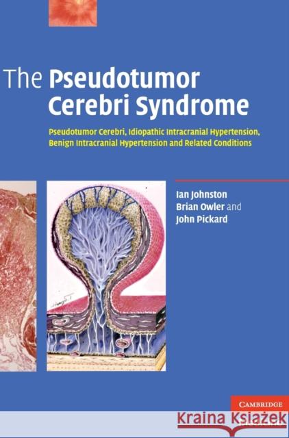 The Pseudotumor Cerebri Syndrome: Pseudotumor Cerebri, Idiopathic Intracranial Hypertension, Benign Intracranial Hypertension and Related Conditions Johnston, Ian 9780521869195 0