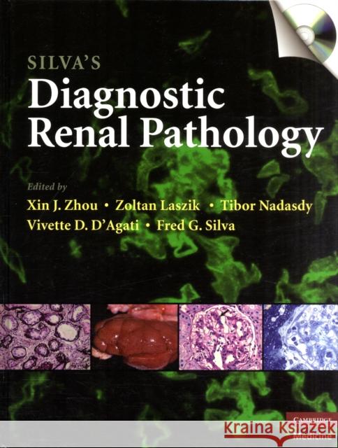 Silva's Diagnostic Renal Pathology [With CDROM] Zhou, Xin J. 9780521877022 0