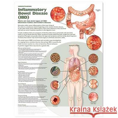 Understanding Inflammatory Bowel Disease (IBD) Anatomical Chart Anatomical Chart Company 9780781786485 Lippincott Williams & Wilkins