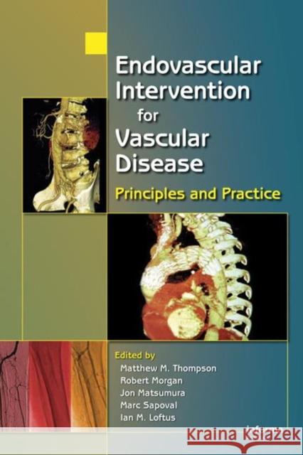 Endovascular Intervention for Vascular Disease: Principles and Practice Thompson, Matt M. 9780849339790 Informa Healthcare