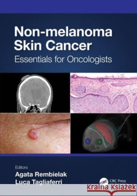 Non-Melanoma Skin Cancer: Essentials for Oncologists Rembielak, Agata 9781032103716 Taylor & Francis Ltd