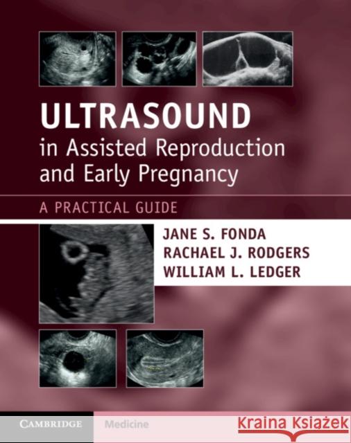 Ultrasound in Assisted Reproduction and Early Pregnancy: A Practical Guide Jane S. Fonda Rachael J. Rodgers William L. Ledger 9781108810210