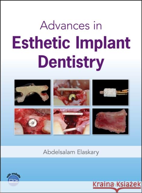 Advances in Esthetic Implant Dentistry Abd El Salam E 9781119286677 Wiley-Blackwell