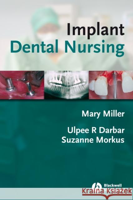 Implant Dental Nursing Mary Miller Ulpee R. Darbar Suzanne Morkus 9781405144285 Wiley-Blackwell