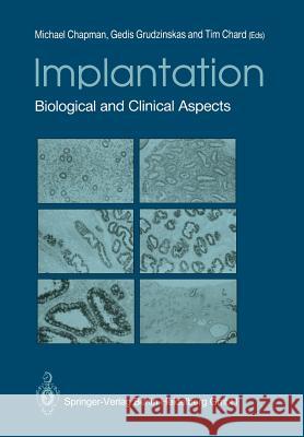 Implantation: Biological and Clinical Aspects Chapman, Michael G. 9781447135319 Springer