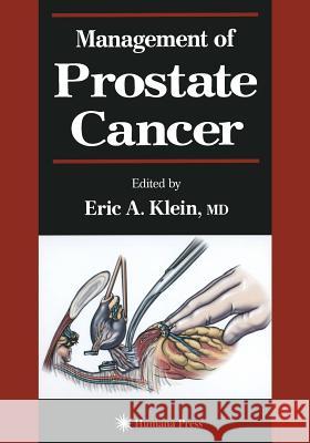 Management of Prostate Cancer Eric A Eric A. Klein 9781468498264 Humana Press