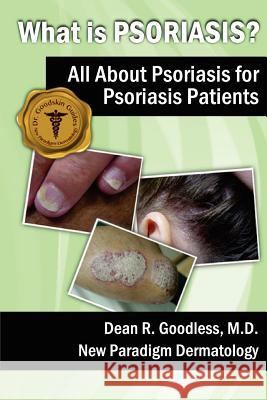 What is Psoriasis?: All About Psoriasis for Psoriasis Patients Goodless MD, Dean R. 9781475132823 Createspace