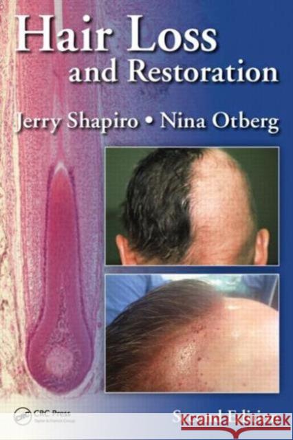 Hair Loss and Restoration Jerry Shapiro 9781482231977