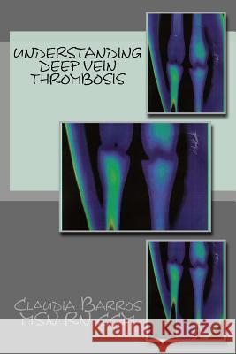 Understanding Deep Vein Thrombosis Claudia Barros 9781539918417