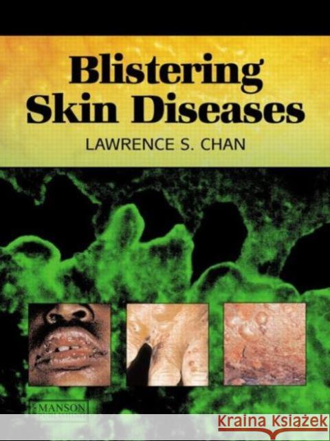 Blistering Skin Diseases Lawrence S Chan 9781840761757
