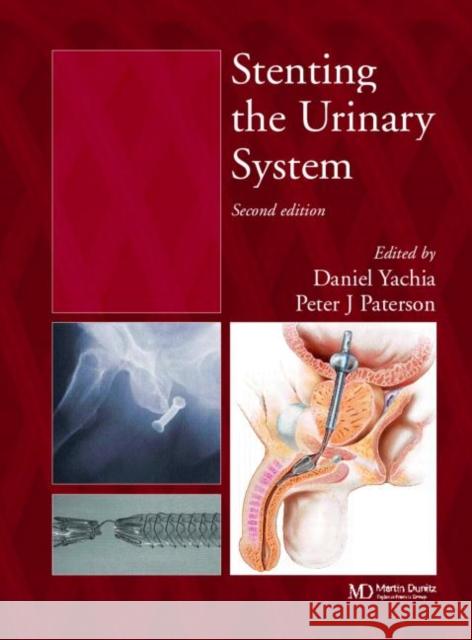 Stenting the Urinary System Daniel Yachia Peter J. Paterson Yachia Yachia 9781841843872 Taylor & Francis Group