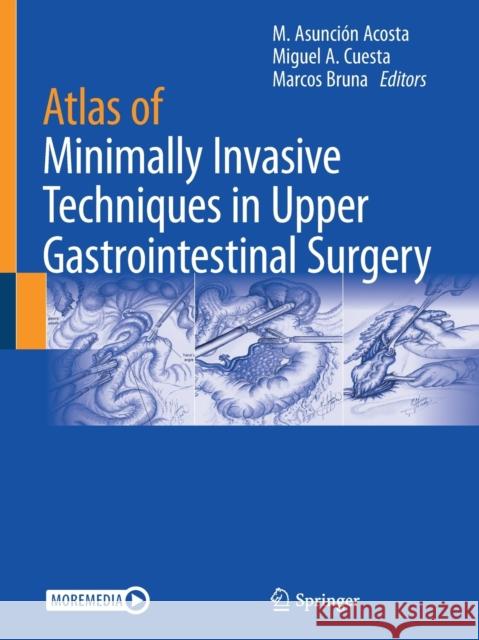 Atlas of Minimally Invasive Techniques in Upper Gastrointestinal Surgery Asunci Miguel a. Cuesta Marcos Bruna 9783030551780