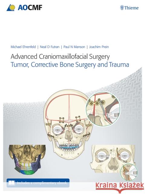 Advanced Craniomaxillofacial Surgery: Tumor, Corrective Bone Surgery, and Trauma Ehrenfeld, Michael 9783132428393 Thieme Medical Publishers