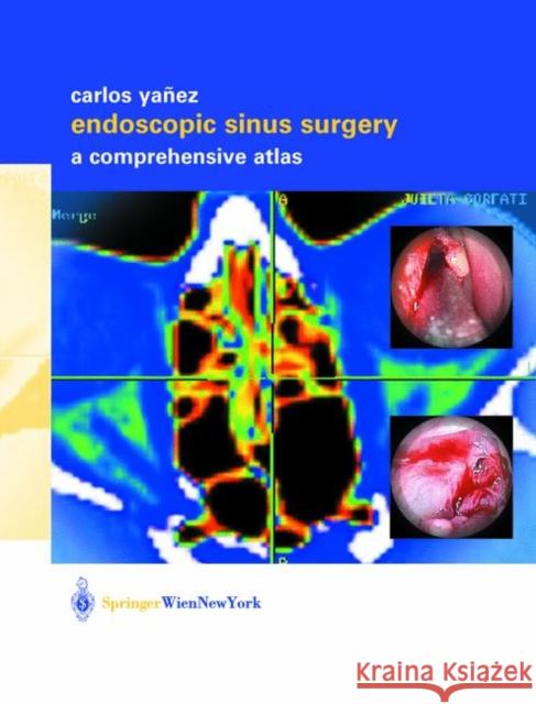Endoscopic Sinus Surgery: A Comprehensive Atlas Yañez, Carlos 9783211837122 Springer