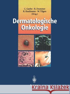 Dermatologische Onkologie Claus Garbe Reinhard Dummer Roland Kaufmann 9783642644801 Springer