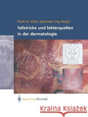 Fallstricke Und Fehlerquellen in Der Dermatologie Köhn, Frank-Michael 9783709171974