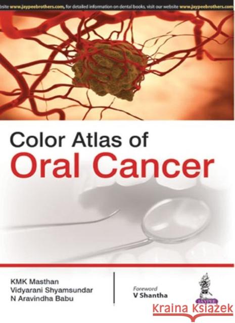 Color Atlas of Oral Cancer K. M. K. Masthan Vidyarani Shyamsundar N. Aravindha Babu 9789351524410 Jaypee Brothers Medical Publishers - książka
