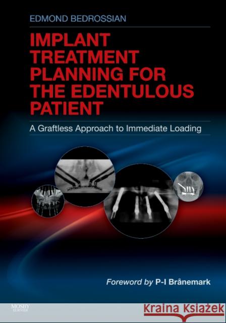 Implant Treatment Planning for the Edentulous Patient: A Graftless Approach to Immediate Loading Bedrossian, Edmond 9780323073684 Mosby - książka