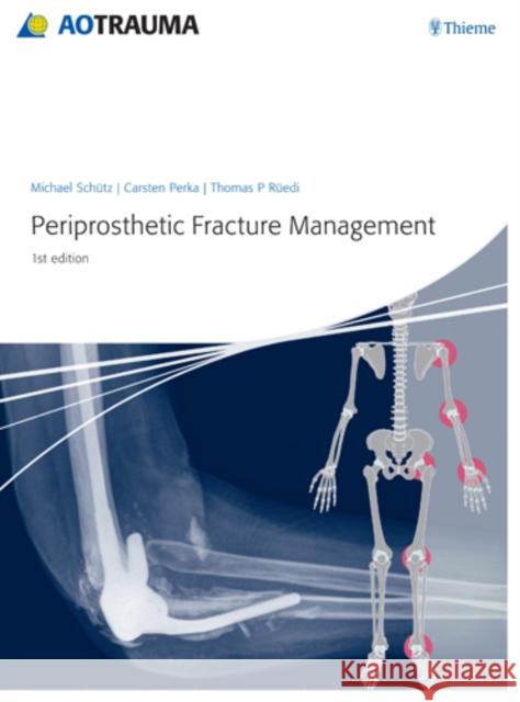 Periprosthetic Fracture Management M Schuetz C Perka T Ruedi 9783131715111 Thieme Publishing Group - książka