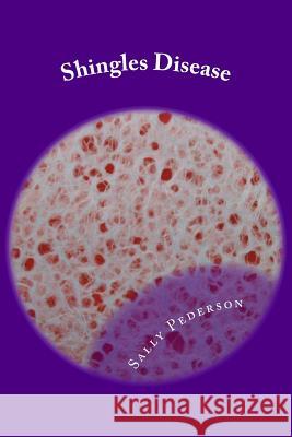 Shingles Disease: The Complete Guide Sally Pederson 9781478290629 Createspace - książka