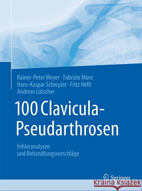 100 Clavicula-Pseudarthrosen: Fehleranalysen Und Behandlungsvorschläge Meyer, Rainer-Peter 9783662553442 Springer - książka
