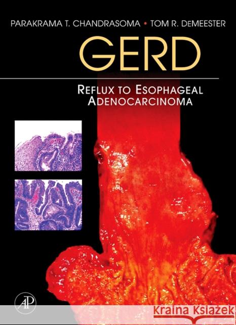 GERD : Reflux to Esophageal Adenocarcinoma Parakrama T. Chandrasoma Tom Demeester Para Chandrasoma 9780123694164 Elsevier Science