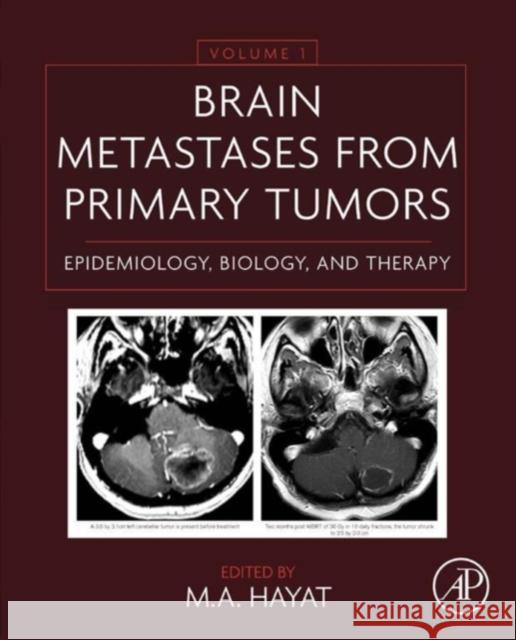 Brain Metastases from Primary Tumors Volume 1: Epidemiology, Biology, and Therapy Hayat, M. A. 9780128008966 Academic Press