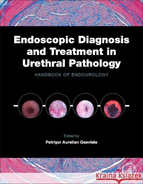 Endoscopic Diagnosis and Treatment in Urethral Pathology: Handbook of Endourology Geavlete, Petrisor Aurelian   9780128024065 Elsevier Science