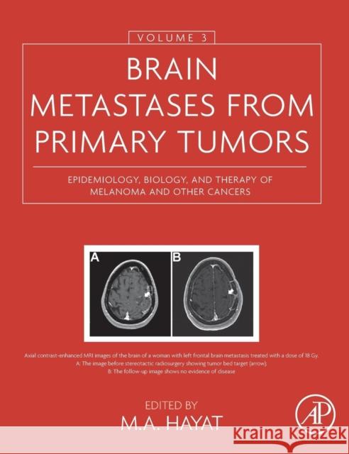 Brain Metastases from Primary Tumors, Volume 3: Epidemiology, Biology, and Therapy of Melanoma and Other Cancers M. Hayat 9780128035085