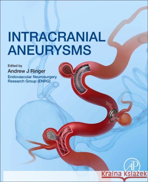 Intracranial Aneurysms Andrew J. Ringer 9780128117408