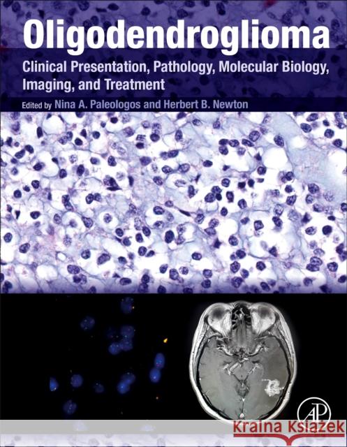 Oligodendroglioma: Clinical Presentation, Pathology, Molecular Biology, Imaging, and Treatment Nina A. Paleologos Herbert B. Newton 9780128131589 Academic Press