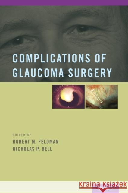Complications of Glaucoma Surgery Robert M Feldman 9780195382365