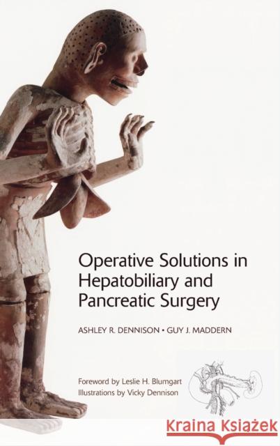 Operative Solutions in Hepatobiliary and Pancreatic Surgery Fiona Creed Christine Spiers Emilia Vynnycky 9780199584178 Oxford University Press, USA