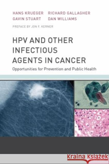 Hpv and Other Infectious Agents in Cancer: Opportunities for Prevention and Public Health Krueger, Hans 9780199732913 Oxford University Press, USA
