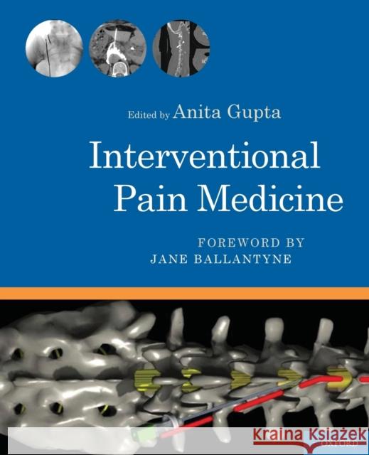 Interventional Pain Medicine Anita Gupta 9780199740604 Oxford University Press, USA