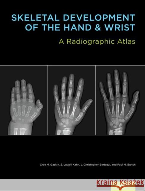 Skeletal Development of the Hand & Wrist: A Radiographic Atlas & Digital Bone Age Companion [With DVD] Gaskin, Cree M. 9780199782055 Oxford University Press, USA