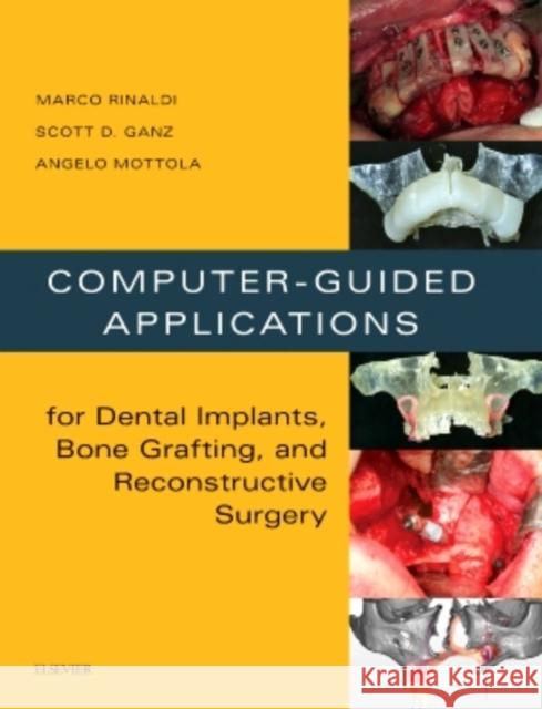 Computer-Guided Applications for Dental Implants, Bone Grafting, and Reconstructive Surgery (Adapted Translation) Marco Rinaldi Scott D. Ganz Angelo Mottola 9780323278034 Elsevier Science Publishing Co Inc