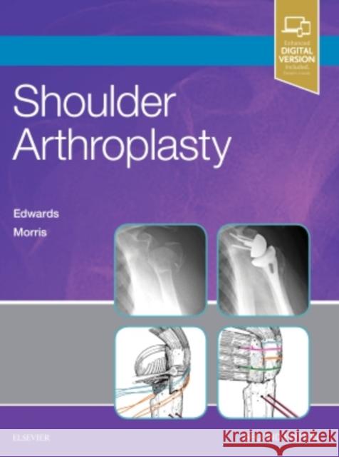 Shoulder Arthroplasty Edwards, T. Bradley 9780323529402 Elsevier