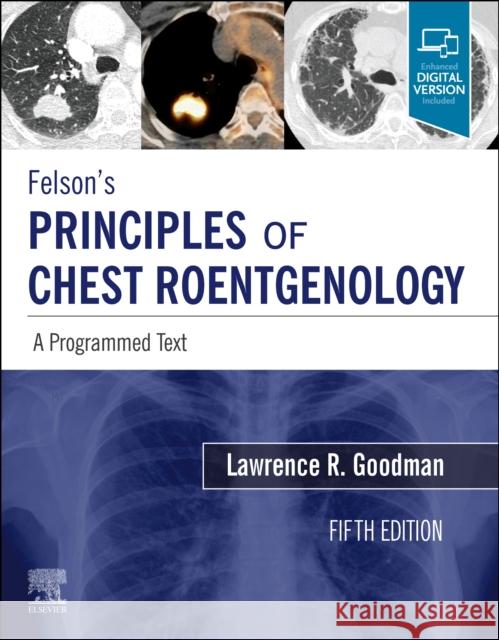 Felson's Principles of Chest Roentgenology, a Programmed Text: A Programmed Text Goodman, Lawrence R. 9780323625678