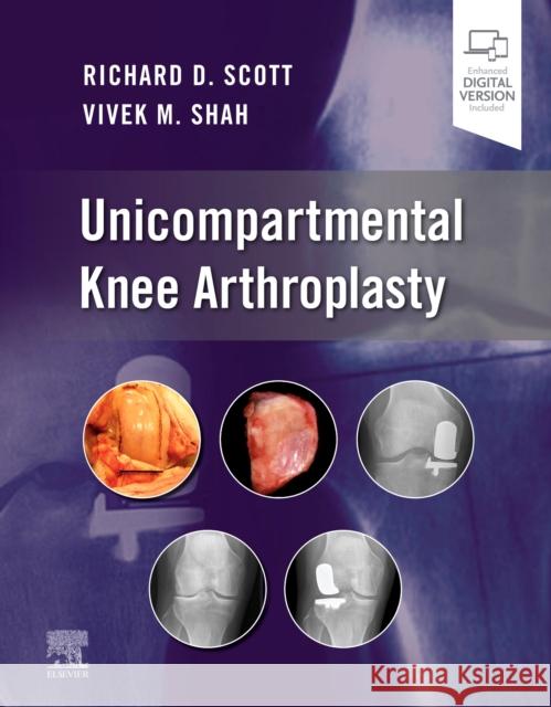 Unicompartmental Knee Arthroplasty Richard D. Scott Vivek Shah 9780323790109