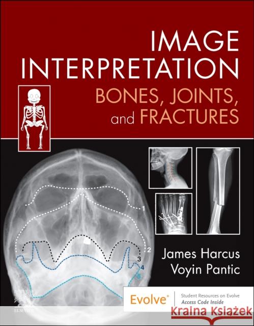 Image Interpretation: Bones, Joints, and Fractures James Harcus Voyin Pantic 9780323870801 Elsevier - Health Sciences Division