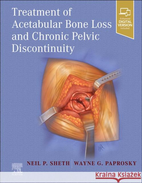 Treatment of Acetabular Bone Loss and Chronic Pelvic Discontinuity Wayne, MD, FACS (Professor, Department of Orthopaedics, Section of Adult Joint Reconstruction, Rush Presbyterian-St. Luk 9780323875509 Elsevier - Health Sciences Division