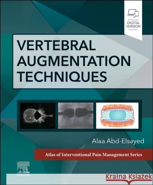 Vertebral Augmentation Techniques Alaa Abd-Elsayed 9780323882262 Elsevier - Health Sciences Division