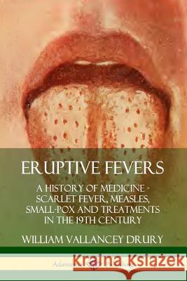 Eruptive Fevers: A History of Medicine - Scarlet Fever, Measles, Small-Pox and Treatments in the 19th Century William Vallancey Drury 9780359733132 Lulu.com