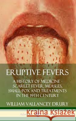 Eruptive Fevers: A History of Medicine - Scarlet Fever, Measles, Small-Pox and Treatments in the 19th Century (Hardcover) William Vallancey Drury 9780359733149 Lulu.com