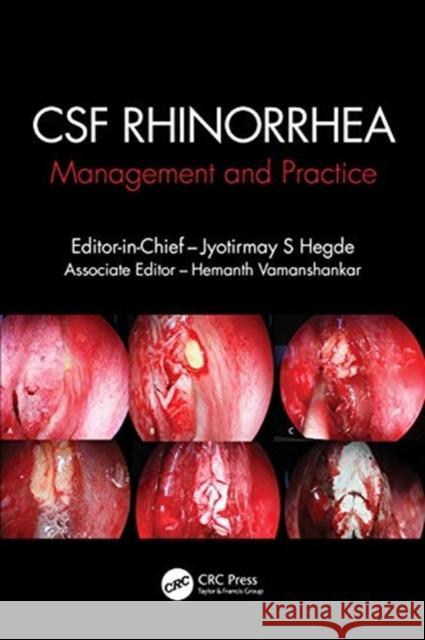 CSF Rhinorrhoea: Management and Practice Hegde, Jyotirmay S. 9780367029586