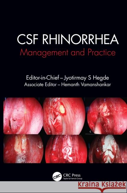 CSF Rhinorrhoea: Management and Practice Hegde, Jyotirmay S. 9780367029630