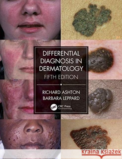 Differential Diagnosis in Dermatology Barbara Leppard 9780367085971 Taylor & Francis Ltd